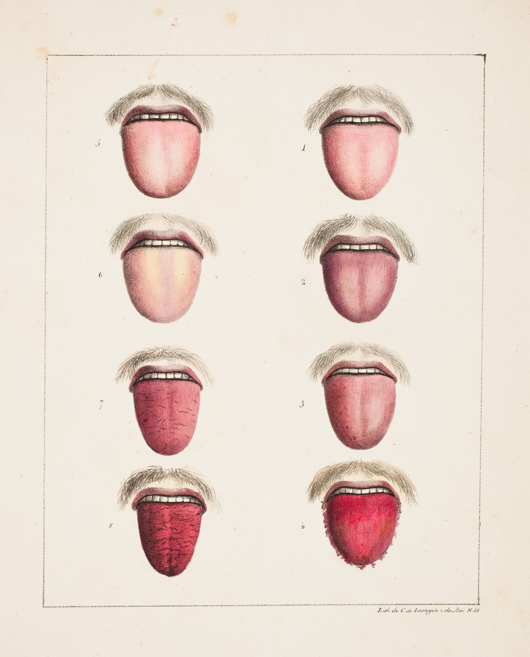 “Observations sur la Fièvre Jaune, faites à Cadix, en 1819” (litografia sulle manifestazioni facciali della febbre gialla), di Estienne Pariset (1770-1847) e André Mazet (1795-1821).