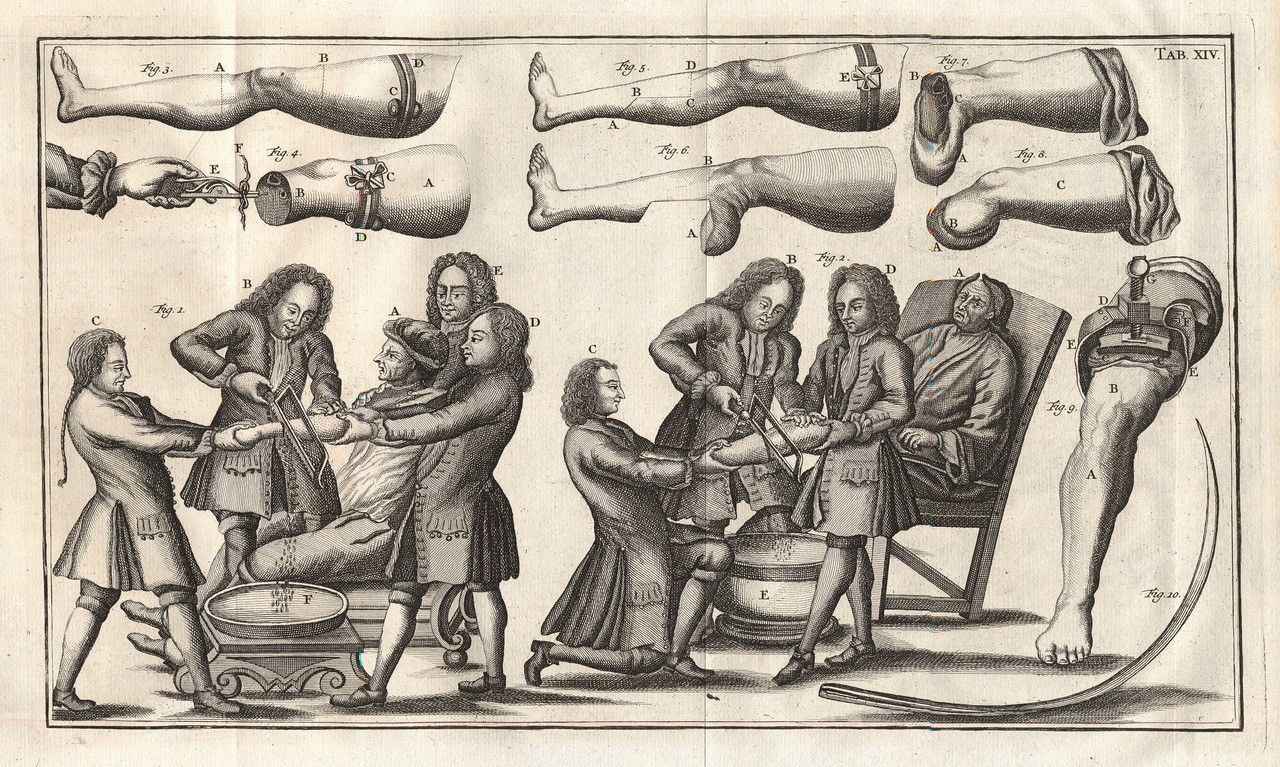 Amputazione. Tavola tratta da “Institutiones chirurgicae”, di Lorenz Heister (1683-1758).